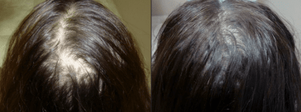 Serum mot håravfall